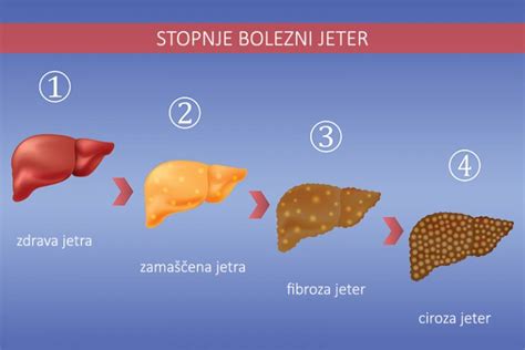 Infografika stopenj bolezni jeter (steatoza, steatohepatitis, fibroza, ciroza)
