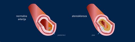 Graf, ki prikazuje naraščanje tveganja za srčno-žilne bolezni glede na pogostost uživanja ocvrte hrane.
