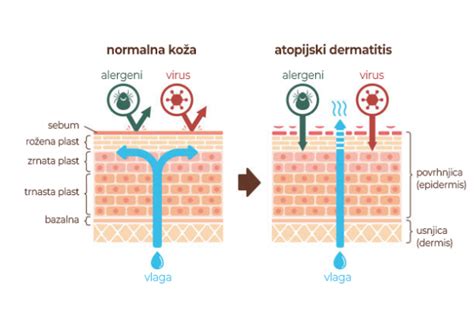 Ilustracija pravilne nege kože pri atopijskem dermatitisu