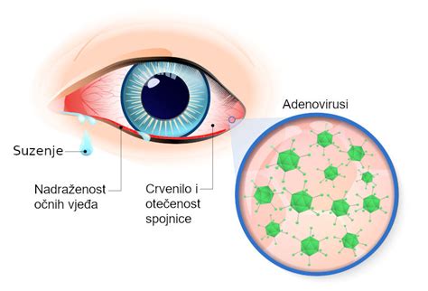 Infografika: simptomi alergijskega konjunktivitisa