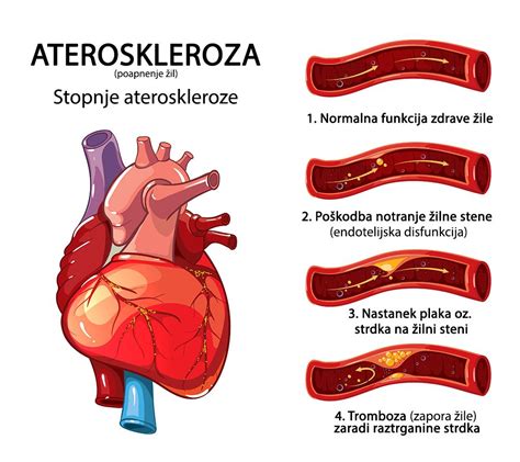 infografika o aterosklerozi in njenih posledicah