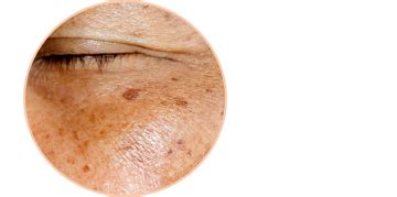 Infografika: nastanek starostnih peg in vloga melanina