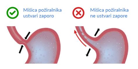 prikaz delovanja mišice zapiralke in poti želodčne kisline nazaj v požiralnik