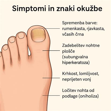 Infografika: Vizualni prikaz simptomov glivičnih okužb na stopalih in nohtih
