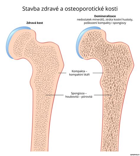 shema zdrave kosti in osteoporozne kosti