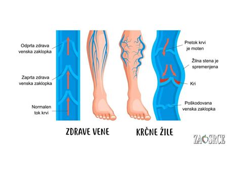 infografika dejavnikov tveganja za krčne žile