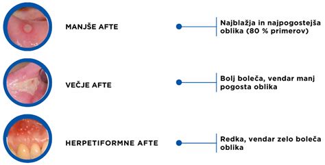 infografika: shema kapsaicina, ki se veže na receptorje v ustih