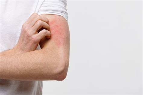 Tematska fotografija: Histamin in alergijske reakcije