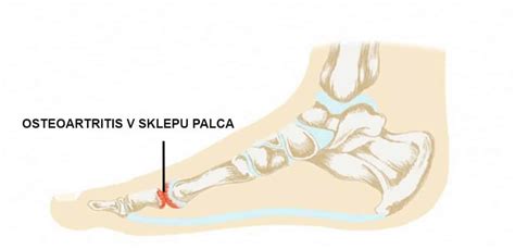 infografika prikazuje nastanek uričnih kristalov v sklepu palca na nogi
