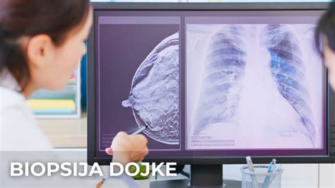 Infografika: Anatomija dojke in prikaz najpogostejših mest za nastanek benignih tvorb.