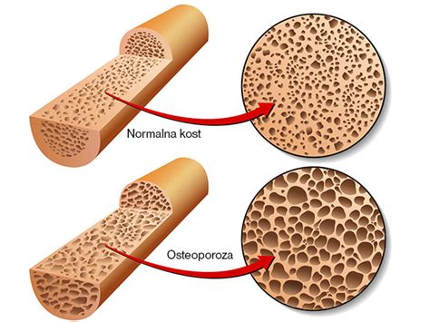 Slikovni prikaz: Razlika med zdravo kostjo in kostjo, ki jo je prizadela osteoporoza