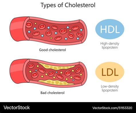 Shema: Razlika med delovanjem HDL (dobrega) in LDL (slabega) holesterola v arterijah